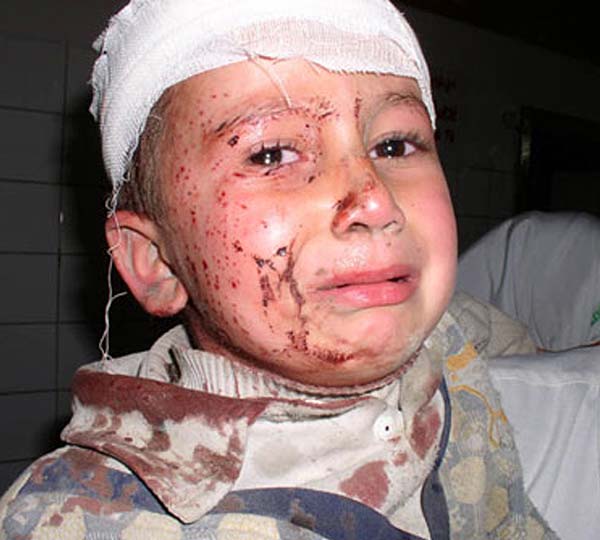  Durch US-Granatsplitter schwerverletzter irakischer Junge ...  |  Foto: April 2003 
